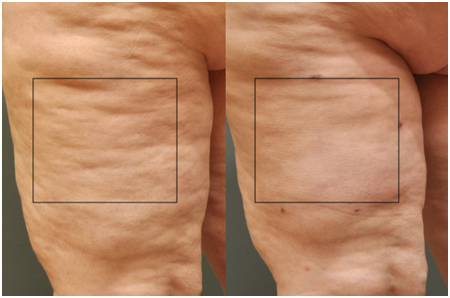 Cellulite reduction techniques for men