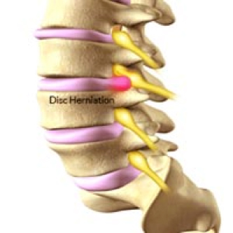 Low-Back-Pain-2