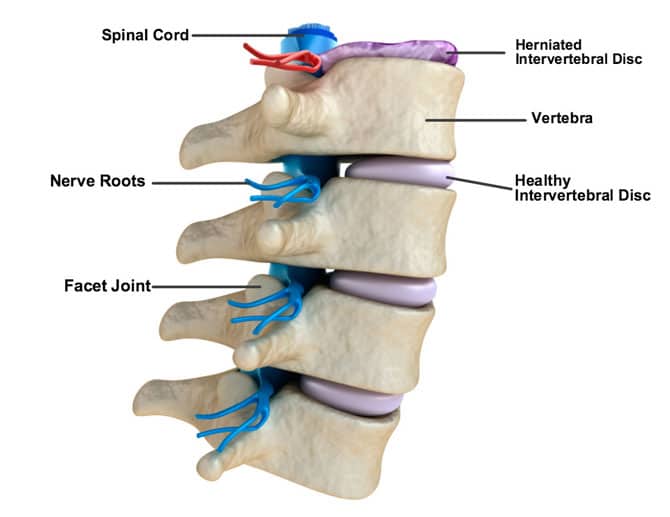 Can I Lift Weights With A Herniated Disc?