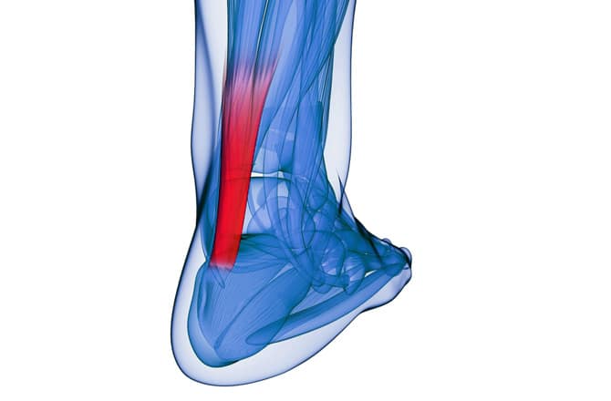 chilles-tendinitis