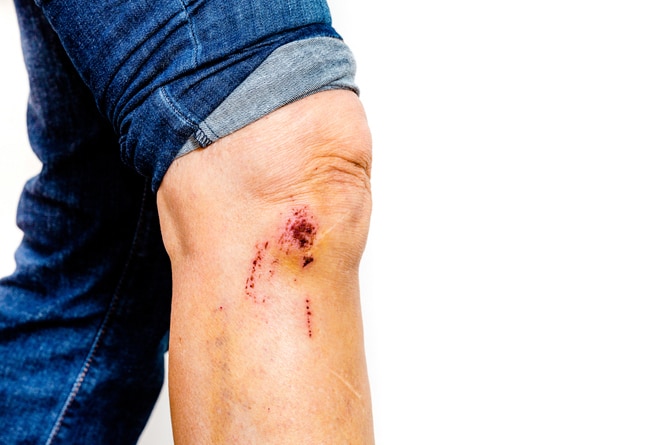 knee-contusion
